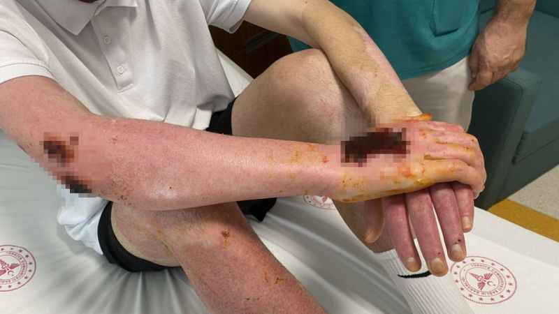 Deodorant sıkılırken çakılan çakmak sonları oluyordu