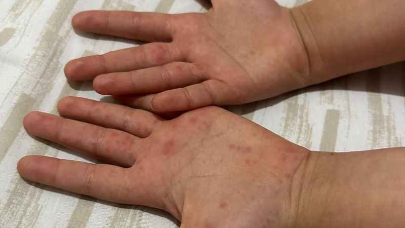 Çocuklarda artan el ayak ağız hastalığına dikkat!