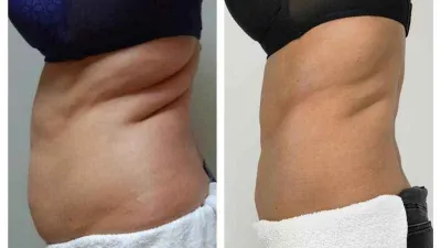 Tek seansta 3.5 santim incelme mümkün