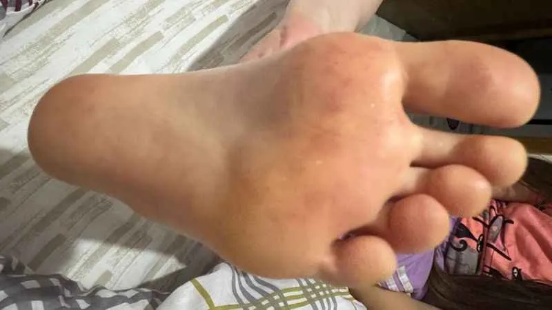 Çocuklarda artan el ayak ağız hastalığına dikkat!